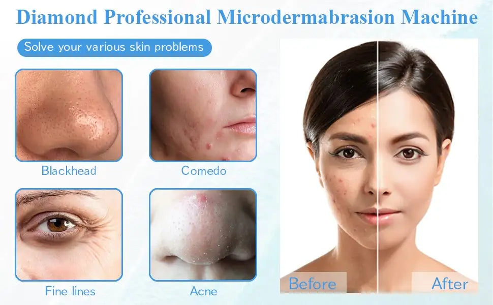 Diamond Microdermabrasion Machine 65-68cmHg Suction Power Professional Dermabrasion ome Use Facial Skin Care Equipment